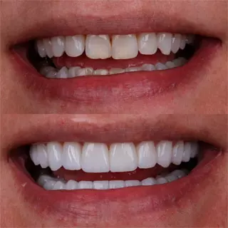 Sorriso com lentes de contato dental em porcelana
