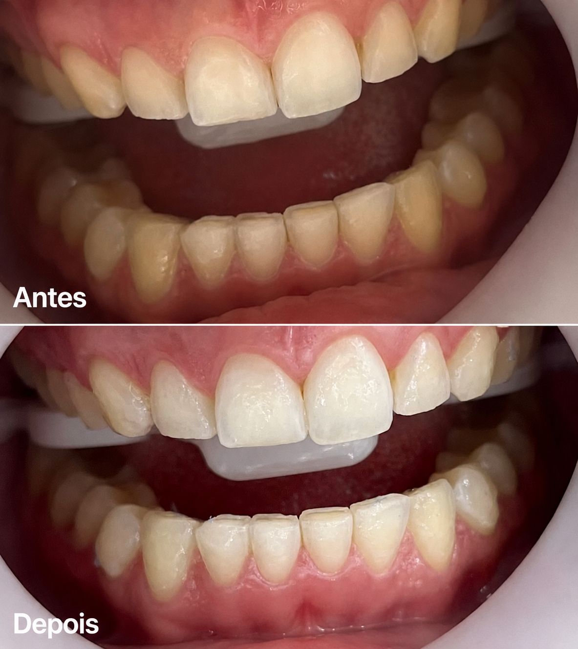 Sorriso branco luminoso após clareamento dental