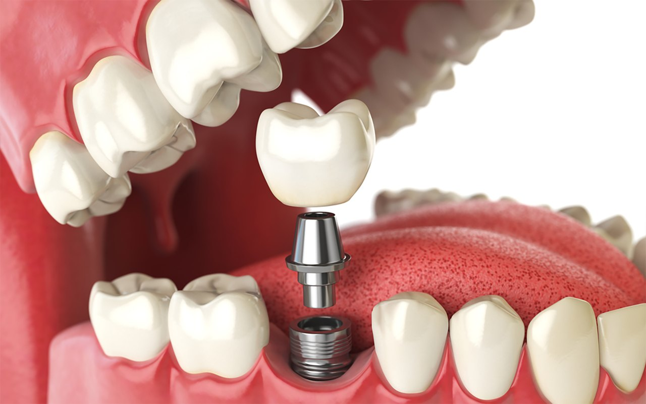 Planejamento digital 3D de implantes dentários